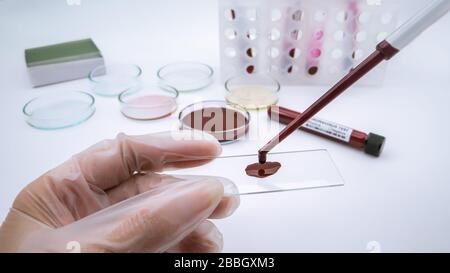 Test del coronavirus nel campione di laboratorio positivo per il sangue. Pandemic Outbreak concetto per covid-19 nuova malattia della SARS dalla Cina. Malattia respiratoria. Foto Stock