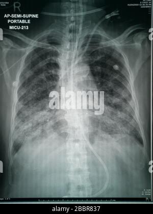 Radiografia toracica del paziente con sospetto virus Corona immagine di alta qualità che mostra cambiamenti nel polmone dovuti al virus Covid-19 con le provette toraciche Foto Stock