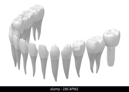 Impianto dentale/impianto dentale Foto Stock