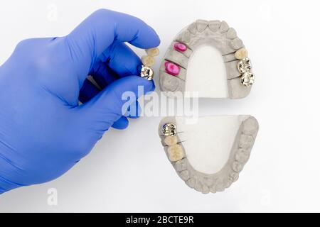 restauro dentistico. protesi dentali. la mano del dentista tiene un modello di denti con corone dentali. isolato Foto Stock