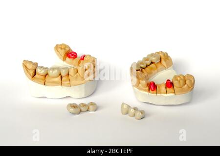 concetto di odontoiatria ortopedica. protesi dentali con corone e ponti ceramici. ponti dentali sui denti posteriori. protesi estetiche. palestra Foto Stock