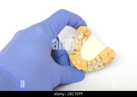 fabbricazione di denti cermet. realizzazione di falsi denti. denti ceramici. ponti ceramici. protesi sui denti Foto Stock