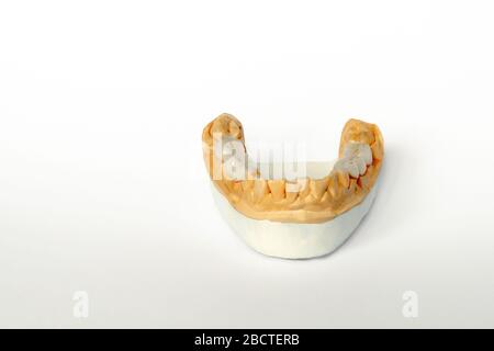 falsi denti. protesi ponte-ceramica-metallo. Dentature in ceramica sul modello in gesso della mascella inferiore Foto Stock