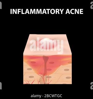 Cisti acne. Furuncle Acne sulla pelle cisti e pimples. Malattie infiammatorie dermatologiche e cosmetiche sulla pelle del viso. Infografica Illustrazione Vettoriale