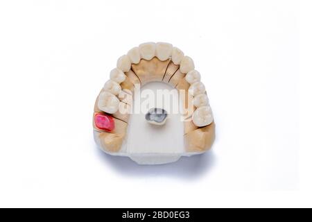 ponte in ceramica-metallo. concetto di protesi con corone in ceramica e ponti in ceramica. le corone sono collocate su un modello in gesso, isolato su uno schienale bianco Foto Stock