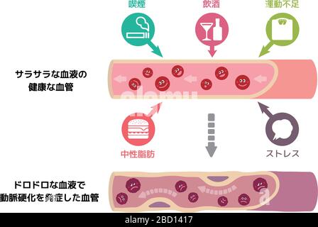 Illustrazione che il sangue sano diventa sangue fangoso a causa di vari fattori malsani, causando arteriosclerosi Illustrazione Vettoriale