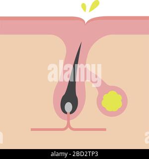Sezione trasversale dei pori (progressione dell'acne) / secrezione eccessiva del sebo Illustrazione Vettoriale