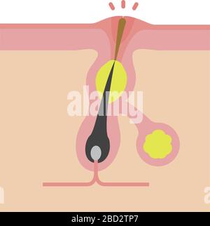 Sezione trasversale dei pori (progressione dell'acne) / Whitehead Illustrazione Vettoriale