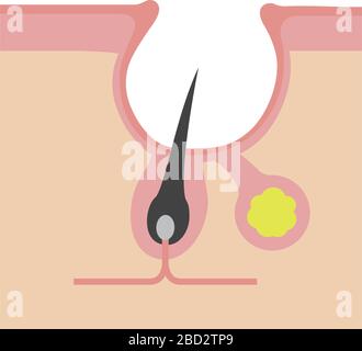 Sezione trasversale dei pori (progressione dell'acne) / Acne cicatrice (cratere) Illustrazione Vettoriale