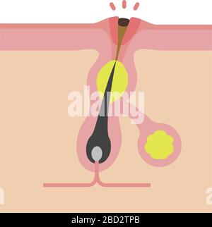 Sezione trasversale dei pori (progressione dell'acne) / Blackhead Illustrazione Vettoriale