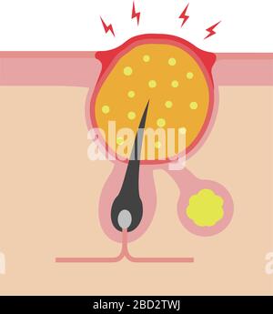 Sezione trasversale dei pori (progressione dell'acne) / bollire Illustrazione Vettoriale