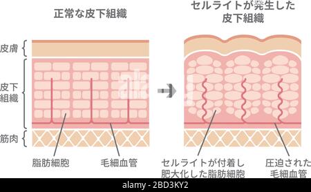 Illustrazione comparativa della pelle normale e della pelle della cellulite Illustrazione Vettoriale