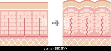 Illustrazione comparativa della pelle normale e della pelle della cellulite Illustrazione Vettoriale