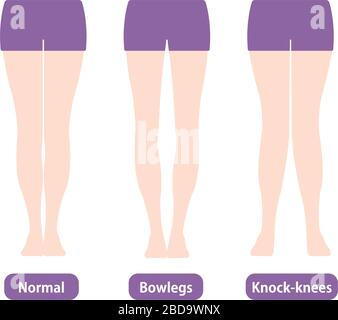Differenze tipi di angoli delle gambe e ginocchia illustrazione vettoriale . Normale, Bowleg, Knock-knockes. Illustrazione Vettoriale