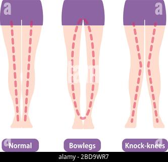 Differenze tipi di angoli delle gambe e ginocchia illustrazione vettoriale . Normale, Bowleg, Knock-knockes. Illustrazione Vettoriale