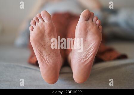 eczema ai piedi di una ragazza giovane. Foto Stock