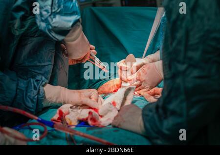 Chirurgia isterectomica, medico chirurgo maschile e infermieri in funzione Foto Stock