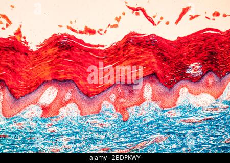 Scar il tessuto della pelle sotto il microscopio 100x Foto Stock