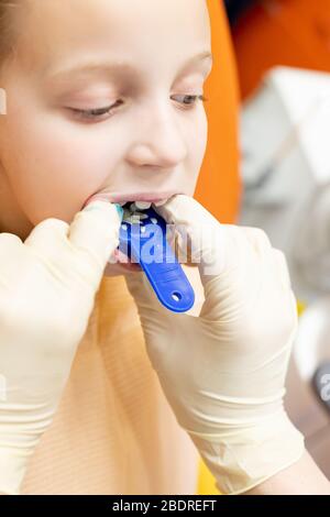 Ortodontista, denti capretti braces, attrezzatura denti cast.disordini dei denti, denti superiori dietro inferiore dents.Blue impronta dentale della tomaia di un bambino Foto Stock