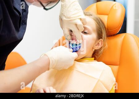 Ortodontista, denti capretti braces, attrezzatura denti cast.disordini dei denti, denti superiori dietro inferiore dents.Blue impronta dentale della tomaia di un bambino Foto Stock