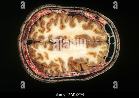 Sezione del cervello umano Foto Stock