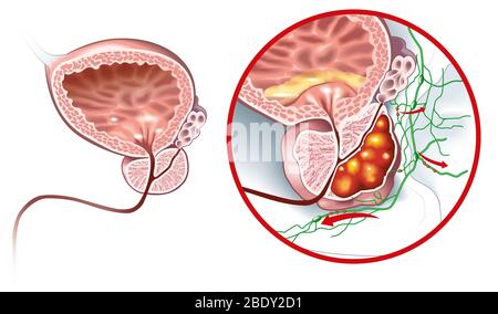 Illustrazione medica che mostra la ghiandola prostatica sana e il cancro della prostata, Foto Stock