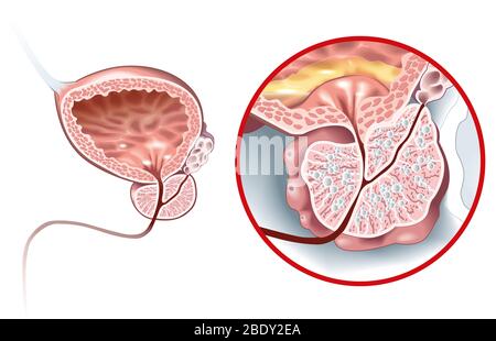 Illustrazione che mostra una prostata sana e iperplasia prostatica benigna (BPH), prostata ingrossata con vescica, uretra e vescicola seminale Foto Stock