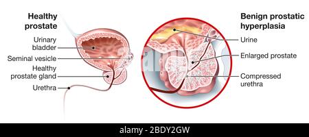 Illustrazione che mostra una prostata sana e iperplasia prostatica benigna (BPH), prostata ingrossata con vescica, uretra e vescicola seminale Foto Stock