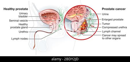 Illustrazione medica che mostra la ghiandola prostatica sana e il cancro della prostata, Foto Stock