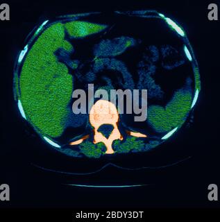 La scoliosi, granuloma & calcificazione nel polmone Foto Stock