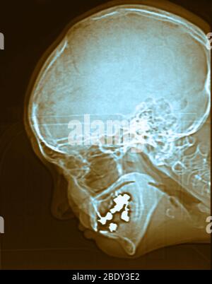 Il normale X-ray dei seni paranasali Foto Stock