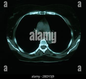 Granuloma & calcificazione nel polmone Foto Stock