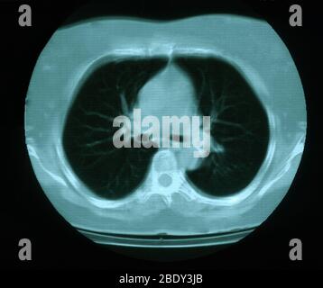 Granuloma & calcificazione nel polmone Foto Stock