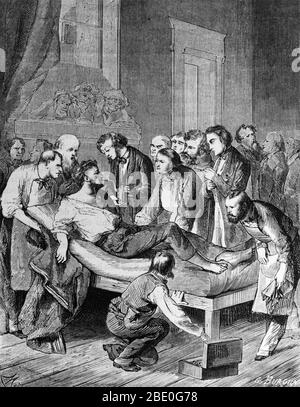 Incisione che mostra ai medici che somministrano etere solforico a un paziente prima di rimuovere un tumore dal collo nel 1846, segnando la prima operazione eseguita in anestesia. Foto Stock