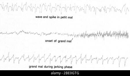 Le crisi epilettiche sono drammaticamente dimostrate dalle tracce EEG. L'attività elettrica più grande e più regolare del cervello si verifica in un attacco di 'piccolo male', anche se il paziente può andare in bianco solo per alcuni secondi. Le fluttuazioni dell'onda e del picco (in alto), esplosioni di energia elettrica, possono coinvolgere quasi tutto il cervello per un minuto o più. Durante il più pericoloso e terrificante 'grande male', in cui il paziente cade a terra, perde cosciente-ness, va rigido e poi strascica violentemente, le tracce mostrano modeste onde 8-al secondo che poi aumentano in frequenza e. Foto Stock