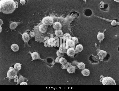 Fase due di una sequenza a sei fasi della morte di una cellula tumorale. Un buffy coat contenente globuli rossi, linfociti e macrofagi viene aggiunto al fondo della membrana. Un gruppo di macrofagi identifica la cellula di cancro come materia estranea e comincia ad attaccarsi alla cellula di cancro, che ancora ha i relativi picchi. Ingrandimento foto: 4000x Foto Stock