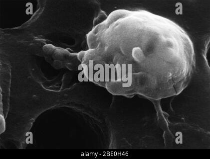 Fase cinque di una sequenza a sei fasi della morte di una cellula tumorale. La cellula di cancro appare grumosa nell'ultimo stadio prima che muoia. Questi grumi sono in realtà i macrofagi fusi all'interno della cellula di cancro. Ingrandimento foto: 56,000x Foto Stock