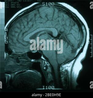 Scansione RM, pesata T1, vista sagittale attraverso il cervello di una femmina di 54 anni. MRI è normale. Foto Stock
