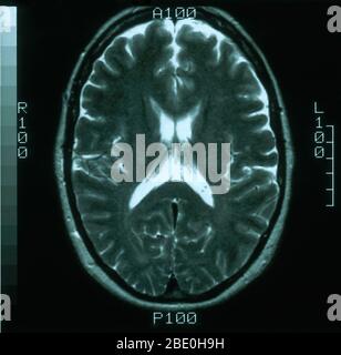 Scansione MRI, pesata T2, vista assiale attraverso il cervello di una femmina di 54 anni. MRI è normale. Foto Stock