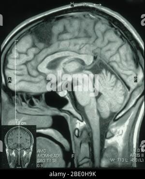 MRI del cervello (vista sagittale) di un maschio di 26 anni. La RM è stata presa come conseguenza di lesioni alla testa in un incidente stradale. La diagnosi della RM è una piccola cisti aracnoidea nella regione anteriore sinistra parasagittale. Tutti gli altri aspetti appaiono normali. Foto Stock