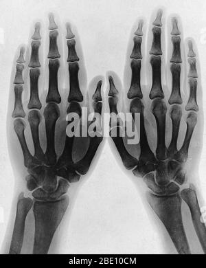 Due mani, viste a raggi X. PhotoPrint dalla radiografia, dopo Sir Arthur Schuster, 1896. Il fisico tedesco Wilhelm Rontgen è solitamente accreditato come scopritore dei raggi X nel 1895, perché è stato il primo a studiarli sistematicamente, anche se non è il primo ad aver osservato i loro effetti. Egli è anche colui che ha dato loro il nome di 'raggi X' (significando una quantità sconosciuta) anche se molti altri si riferivano a questi come 'raggi Rontgen' (e i relativi radiogrammi a raggi X come, 'Rontgenogrammi' per diversi decenni dopo la loro scoperta. Foto Stock