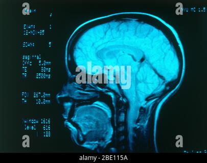 Angiografia radiologica medica che mostra vasi sanguigni normali nel cervello. Foto Stock