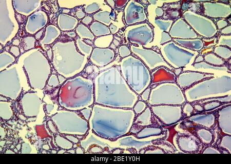 Gozzo con malattia colloidale della tiroide 100 volte Foto Stock