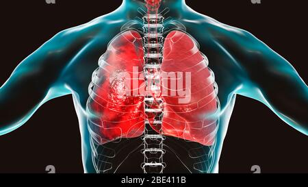 Polmonite, illustrazione. La polmonite è una condizione infiammatoria del polmone. Foto Stock