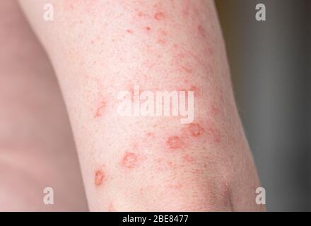 Corpo in primo piano con eruzione cutanea allergica, eczema sulle mani, pelle con protuberanze rosse e vesciche Foto Stock