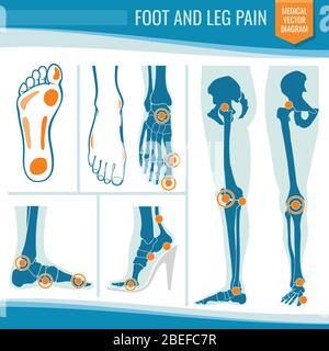 Dolore ai piedi e alle gambe. Artrite e reumatismo diagramma vettoriale medico ortopedico. Illustrazione dell'articolazione delle gambe reumatismi Illustrazione Vettoriale