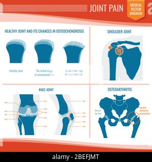 Osteoartrite e reumatismo dolore articolare infografica su vettore medico. Artrite e reumatismi, osteoartrite, ortopedica medica Illustrazione Vettoriale