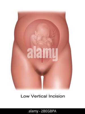 Incisione cesareo verticale bassa, illustrazione Foto Stock