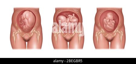 Posizioni del feto in utero, illustrazione Foto Stock