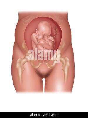 Feto in posizione Breech, illustrazione Foto Stock